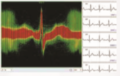 ENDO ECG Holter Monitoring EI.HM