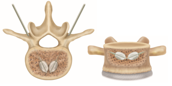 Guardian Balloon Kyphoplasty System