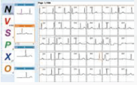 ENDO ECG Holter Monitoring EI.HM12Ch