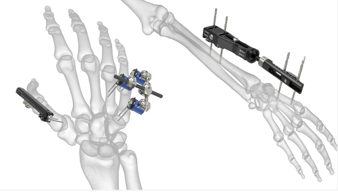 External Fixator System