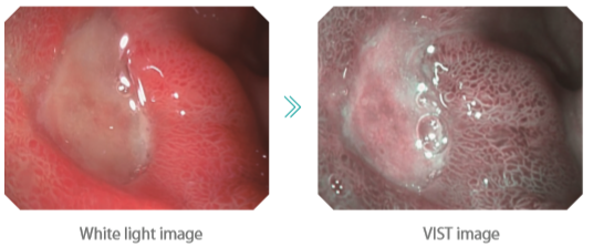 HD-500 Flexible Endoscopy System