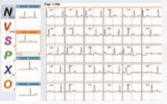 ENDO ECG Holter Monitoring EI.HM